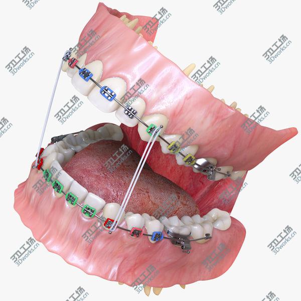 images/goods_img/20210312/Permanent Dentition with Braces/1.jpg